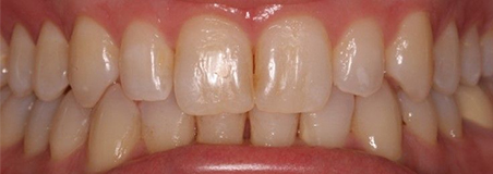 After Treatment