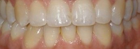 After Treatment