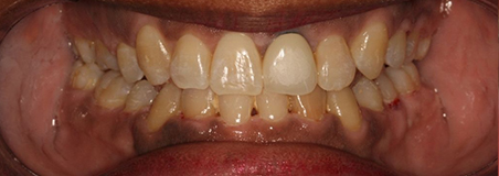 After Treatment