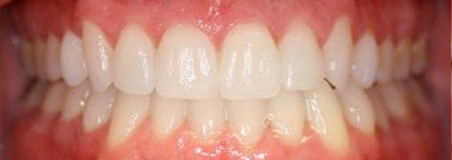 After Treatment