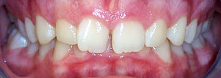 Before Treatment