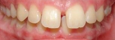 Before Treatment