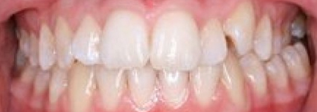 Before Treatment