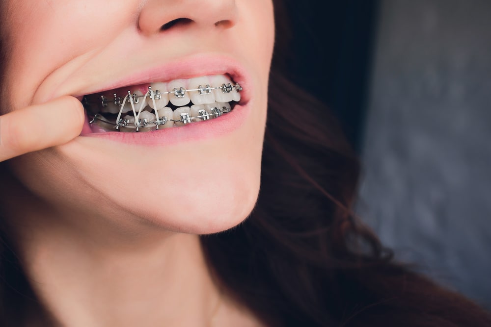 How? Orthodontic Treatment Works - Quarry Orthodontics in Baltimore, MD