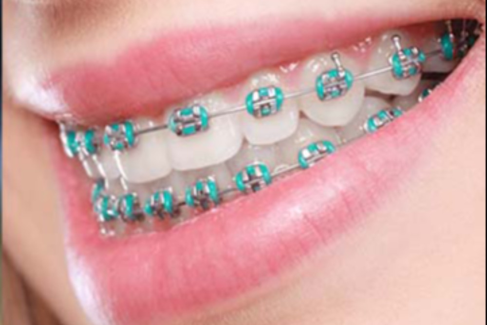 Treatment options for adults - Quarry Orthodontics in Baltimore, MD