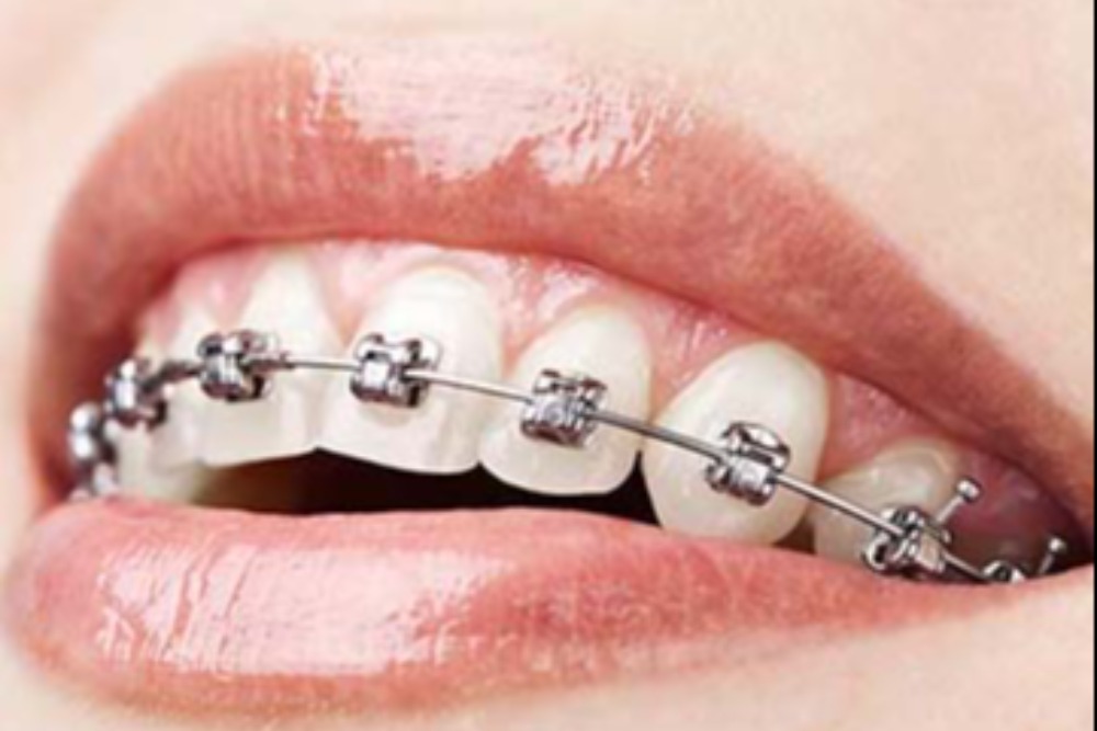 Treatment options for adults - Quarry Orthodontics in Baltimore, MD