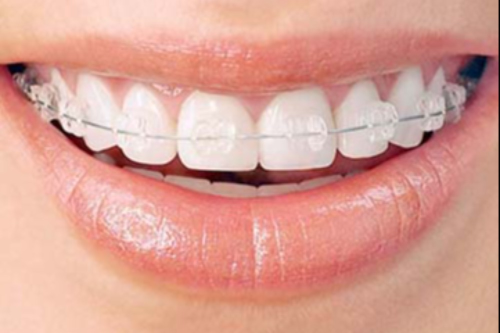 Treatment options for adults - Quarry Orthodontics in Baltimore, MD