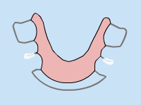 Loose Appliance - Quarry Orthodontics in Baltimore, MD