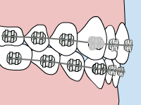 Loose Bracket - Quarry Orthodontics in Baltimore, MD
