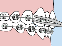 Loose Wire - Quarry Orthodontics in Baltimore, MD