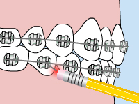 Poking Wire - Quarry Orthodontics in Baltimore, MD