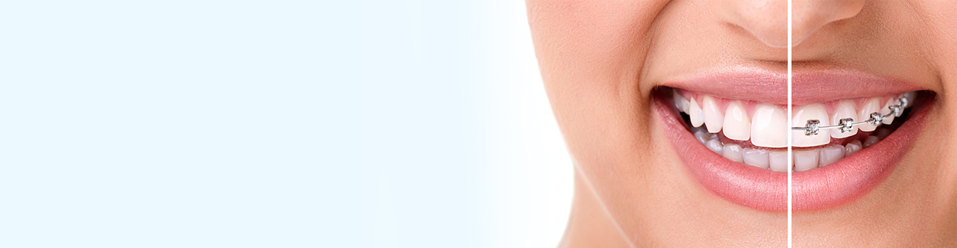 Clear Aligners - Quarry Orthodontics in Baltimore, MD