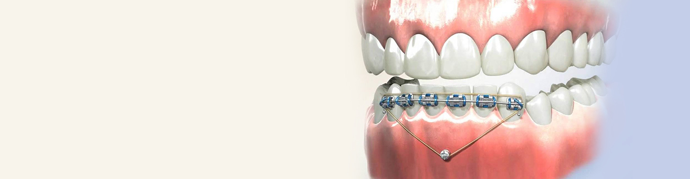 TADs - Quarry Orthodontics in Baltimore, MD