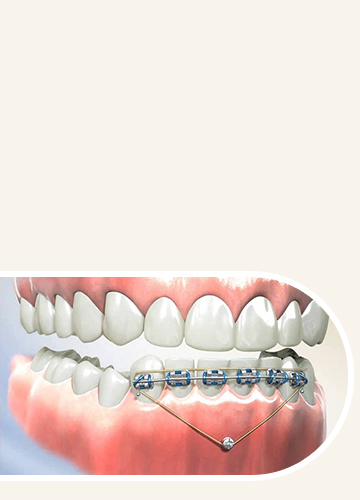 TADs - Quarry Orthodontics in Baltimore, MD