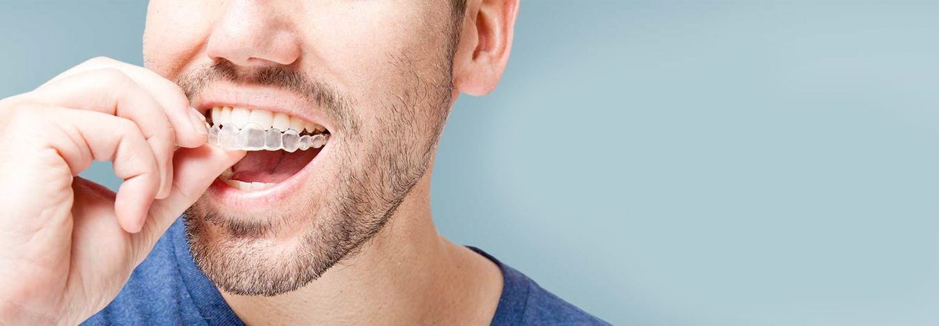 Invisalign clear aligners