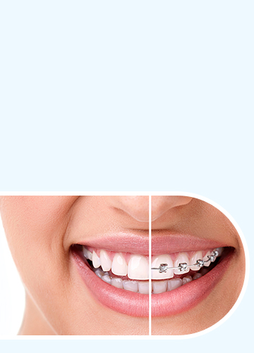 Clear Aligners - Quarry Orthodontics in Baltimore, MD