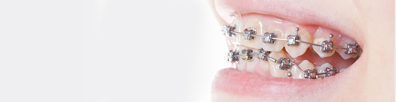 Self-Ligating Braces - Quarry Orthodontics in Baltimore, MD