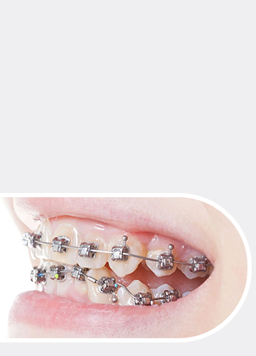 Self-Ligating Braces - Quarry Orthodontics in Baltimore, MD