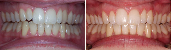 Braces before and after result, patient case 1 - Quarry Orthodontics