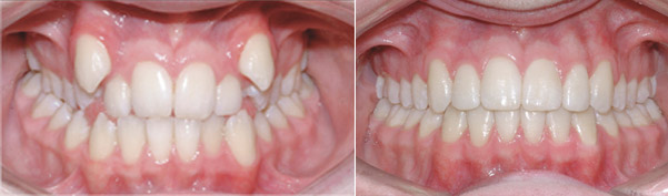 Braces before and after result, patient case 10 - Quarry Orthodontics