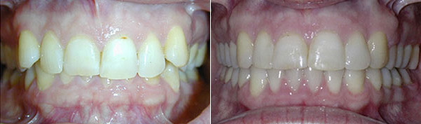 Braces before and after result, patient case 2 - Quarry Orthodontics