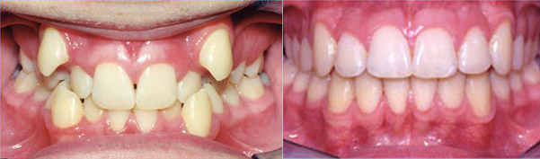 Braces before and after result, patient case 3 - Quarry Orthodontics