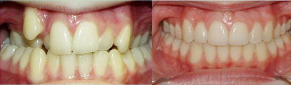 Braces before and after result, patient case 4 - Quarry Orthodontics