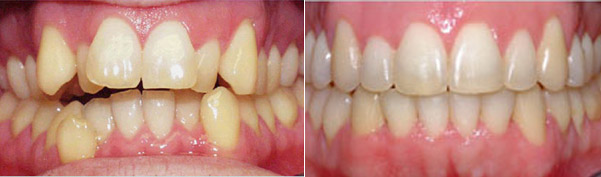 Braces before and after result, patient case 5 - Quarry Orthodontics