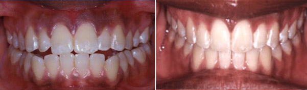 Braces before and after result, patient case 6 - Quarry Orthodontics