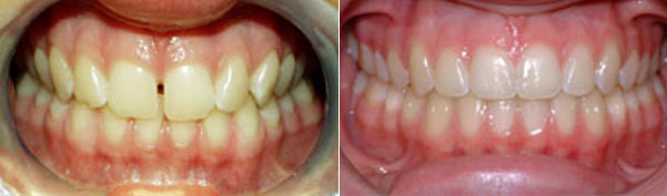 Braces before and after result, patient case 7 - Quarry Orthodontics