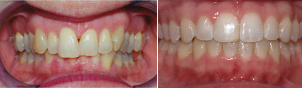 Braces before and after result, patient case 8 - Quarry Orthodontics
