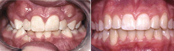 Braces before and after result, patient case 9 - Quarry Orthodontics