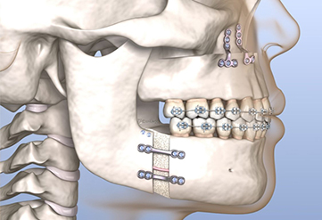 Surgical Orthodontics - Quarry Orthodontics in Baltimore, MD