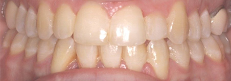 After Treatment