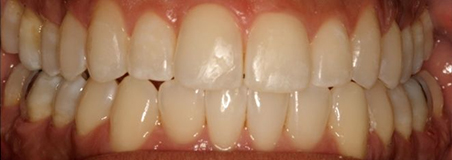 After Treatment