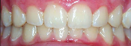 After Treatment