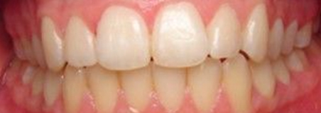 After Treatment