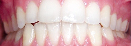After Treatment