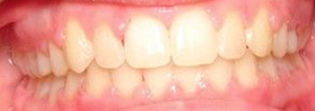 After Treatment