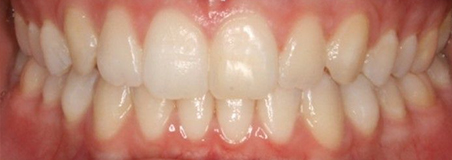 After Treatment