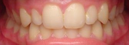 After Treatment