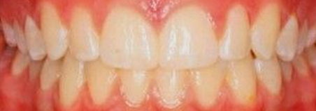 After Treatment