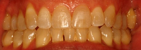 After Treatment