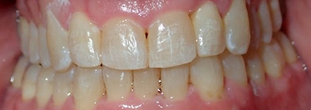 After Treatment