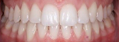 After Treatment
