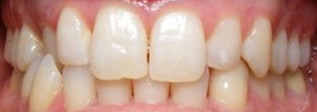Before Treatment