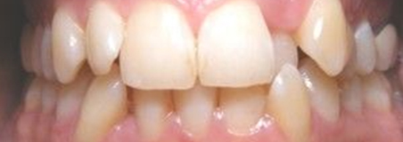 Before Treatment
