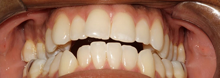 Before Treatment