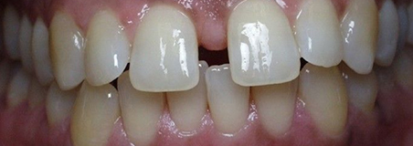 Before Treatment