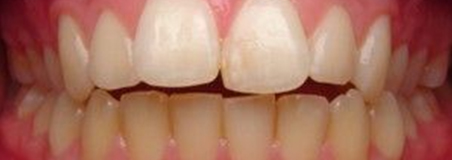 Before Treatment